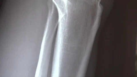 X ray of knee joint anatomy with tibia a... | Stock Video | Pond5