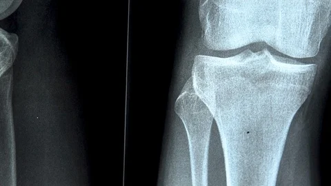 X-ray of the knee joint close-up. X-ray image from bottom to top Video stock 122519595