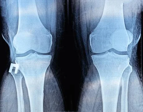 X-ray of Knee joint dislocation after accident. Patellar joint instability... Stock Photos