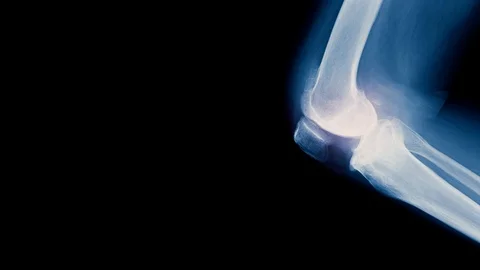 X-ray knee joint show osteoarthritis knee joint Stock Footage 107858211