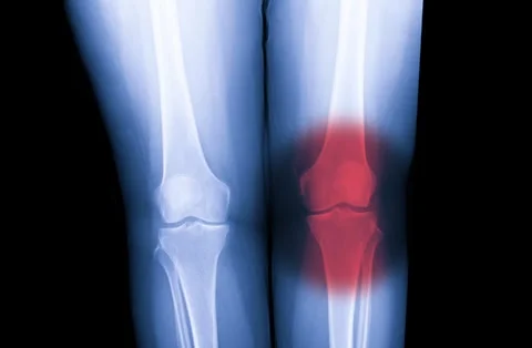 X-ray knee joint show OA knee and pain in joint Vidéo 240137718
