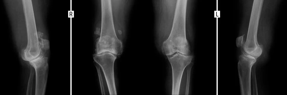 X-ray of the knee joints. Deforming arthrosis. Stock Photos