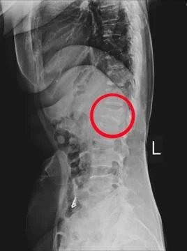 X-ray L-S Spine LATERAL: Finding Moderate compression fracture of L1 vertebra Stock Photos