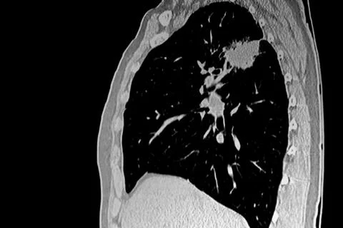 X Ray: lateral view of lung tumor Stock Photos