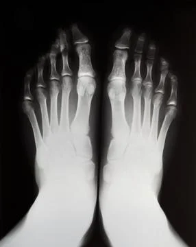 X-ray of the left and right feet. Stock Photos