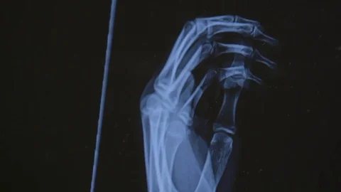 X-ray of left hand Stock Footage 83867074
