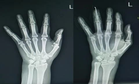 X-ray left hand two views finding normal and fracture finger. Stock Photos