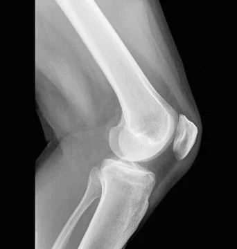 X-ray of left knee of 53-year-old caucasian man from side. Stock Photos