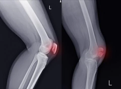 X-ray Left Knee lateral Showing Kneecap normal and fracture red color marker. Stock Photos