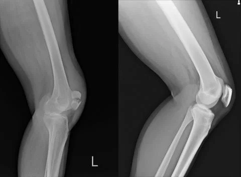 X-ray Left Knee lateral Showing Kneecap fracture and Normal. Stock Photos