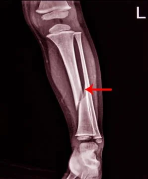 X-ray Left Leg AP Lat fracture Tibia. Stock Photos