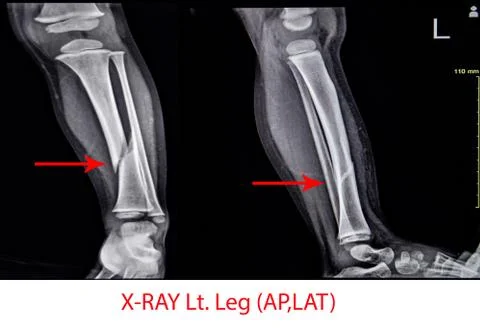 X-ray Left Leg AP Lat fracture Tibia. Stock Photos
