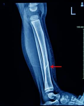 X-ray Left Leg AP Lat fracture Tibia. Stock Photos