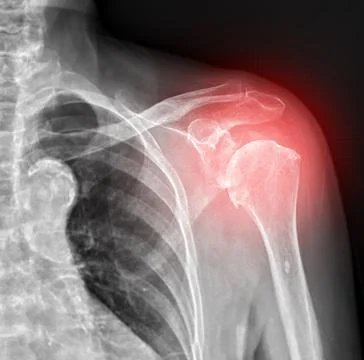 X-ray of left shoulder joints, front view. Stock Illustration