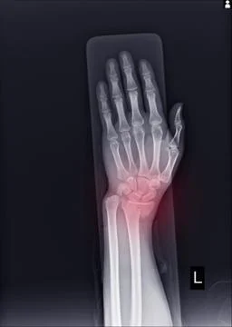X-ray Left wrist joint Fracture with displacement distal end left radius. Stock Photos