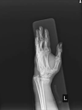 X-ray Left wrist joint Fracture with displacement distal end left radius. Stock Photos