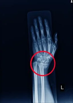X-ray Left wrist joint Fracture with displacement distal end left radius. Stock Photos