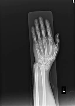 X-ray Left wrist joint Fracture with displacement distal end left radius. Stock Photos