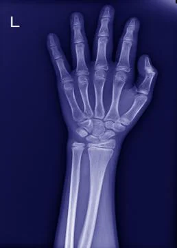 X-ray left wrist No fracture and normal joint. Stock Photos