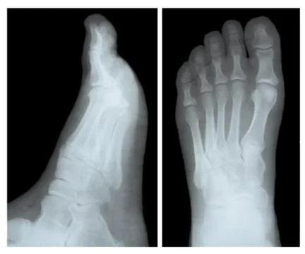 X-ray of leg bones Stock Photos
