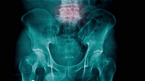 X-ray lower back with animation  Stock Footage 148598886