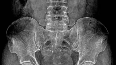 X-ray lower back with animation  Stock Footage 148643422