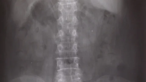 X-ray lumba-sacral spine, pelvis, hip joint,shot moving by dolly Vidéo 85388076