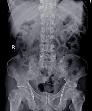 X-ray Lumbar spine impression: Multiple bone metastasis. Stock Photos