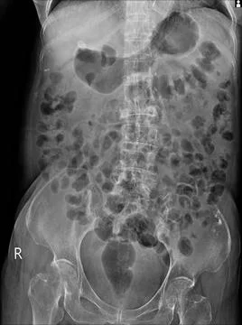 X-ray  of lumbar spine  the study reveals burst fracture of L2 vertebral body Stock Photos