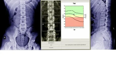 X-ray lumbo-sacral spine and pelvis and inflammation at spine and bone densit Stock Photos
