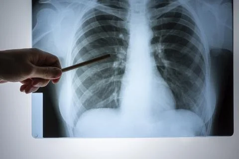 X-ray of the lungs. Chest x-ray. Doctor's view of the lung image in the hos.. Stock Photos