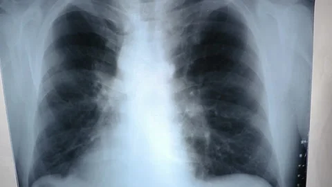 X-ray of lungs close-up view Stock Footage 134895296