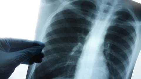 X-ray of lungs. Concept coronavirus theme. Stock Illustration