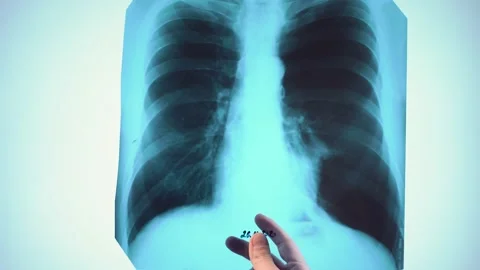 X-ray of the lungs. Coronavirus or COVID 19 Stock Footage 147212422