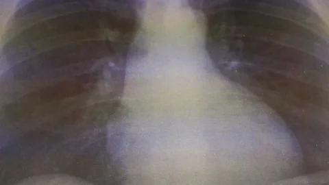 X-ray of the lungs Stock Footage 130623743