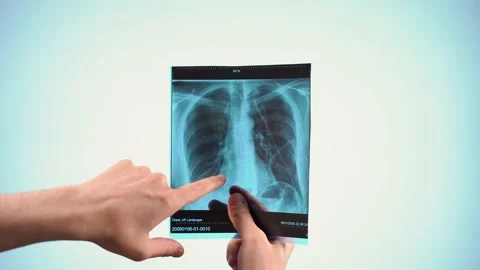 X-ray of the lungs Stock Footage 147212439