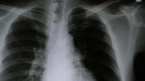 X-ray of lungs moving shot by dolly Stock-Footage 85389116