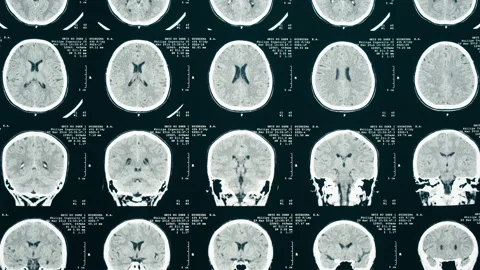 X-ray, Magnetic resonance image of head. Doctor examining human brain MRI close Vídeo Stock 169198624