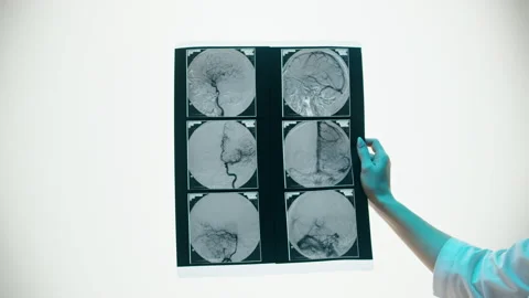 X-ray, Magnetic resonance image of head. Doctor examining blood vessels, human Stock Footage 169198742