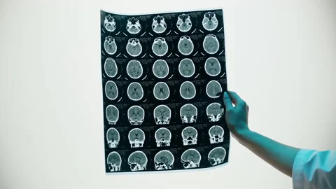 X-ray, Magnetic resonance image of head. Doctor examining human brain MRI close Stock Footage 169198848