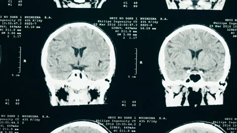 X-ray, Magnetic resonance image of head. Doctor examining human brain MRI close Stock Footage 169198996