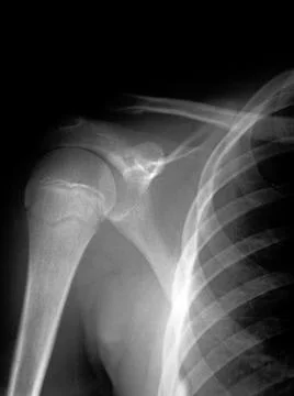 X ray of Man's dislocated shoulder Stock Photos