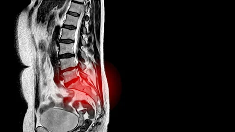 Mri Back Pain Stock Footage ~ Royalty Free Stock Videos | Pond5