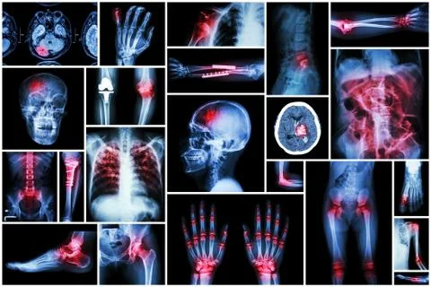 X-ray multiple disease ( stroke (CVA) , fracture , shoulder dislocation , bow Stock Photos