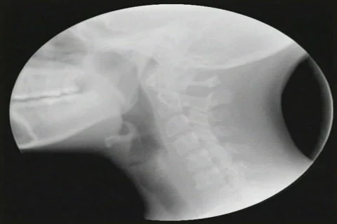 X-ray of Neck Stock Footage 41878955