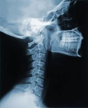 X-ray of the neck Foto stock