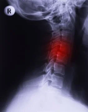 X-ray of neck Stock Photos