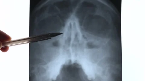 X-ray of Nose trauma 스톡 동영상 321410565
