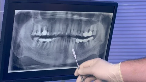 X-ray panoramic picture of the teeth and a dentist's hand with the tool moves Stock-Footage 72789223