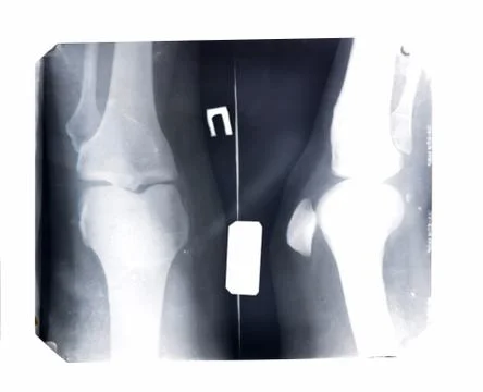 X-ray of the patella Stock Photos